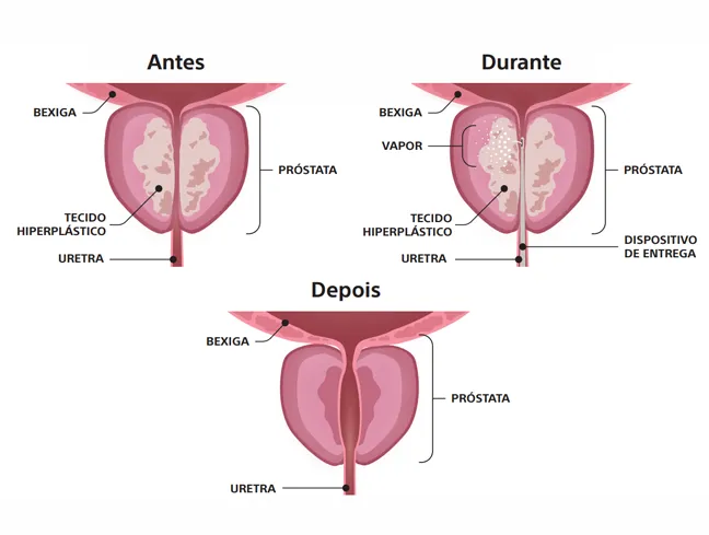 Antes, durante e depois de Rezūm™