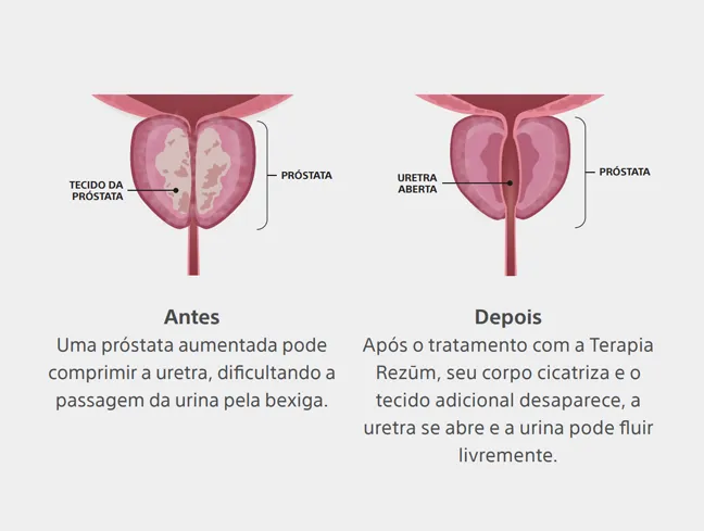 Saiba mais sobre a Terapia  Rezūm™